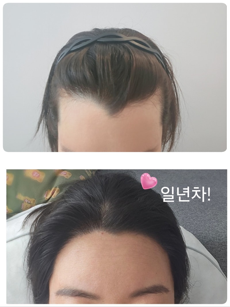 전 이제 M자 아닌 여자에요 ~ 드디어 1년 졸업후기!!!!!