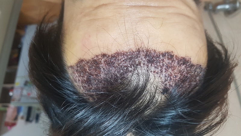 手术后1周结痂比较多吗？