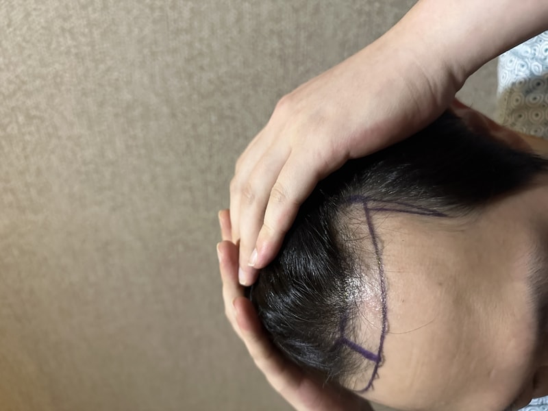 뉴헤어 1600모낭 비절개 이식 2일차