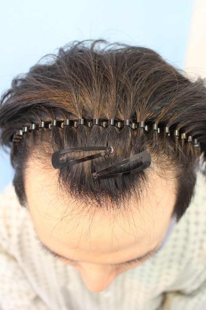 [Hannabe] M-shaped incision 3000mo 9 months review.
