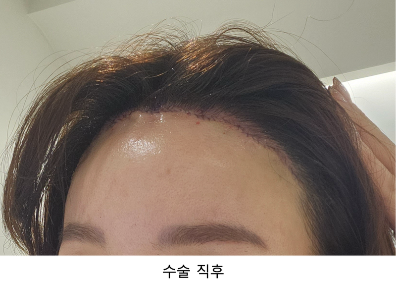 바람부는날에도 성형외과 이마축소 후기