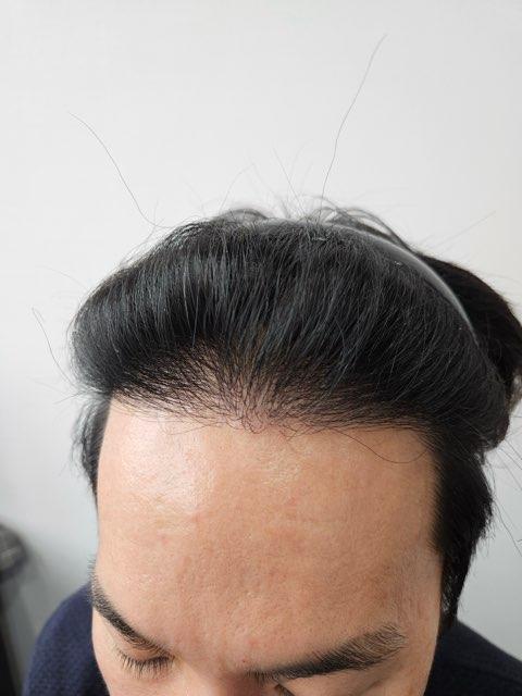 비절개 1년차 경과