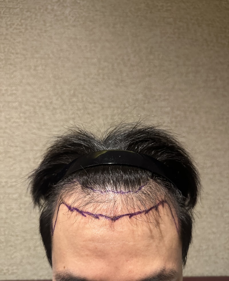 비절개 1800모 수술 후기입니다