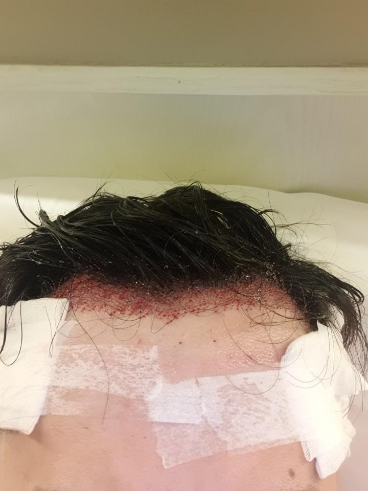 2700毛の鼻切開移植！