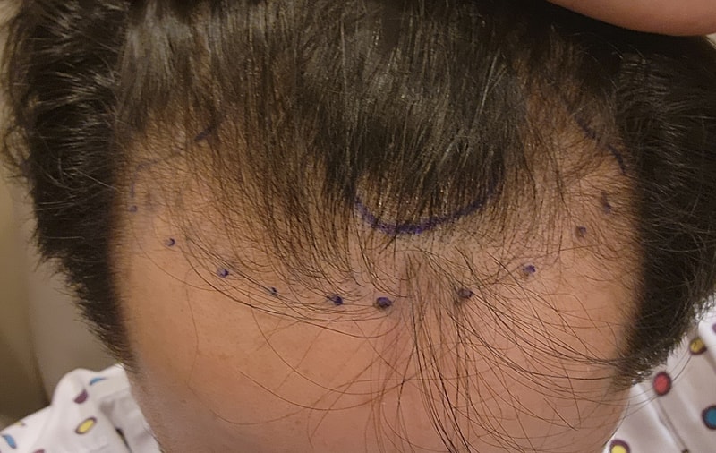 움찬의원 비절개 모발이식 3500모