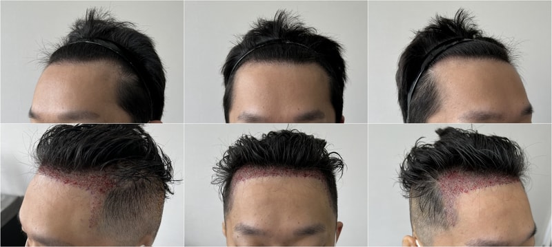 This is the first day of the maternal male M-shaped 1,500 hair follicle transplant
