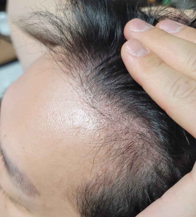This is the second month of the maternal male M-shaped 1,500 hair follicle transplant