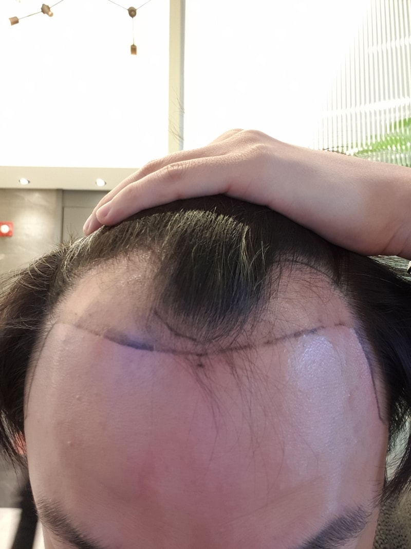 광주 압구정모비앙의원 M자 절개 7개월후기