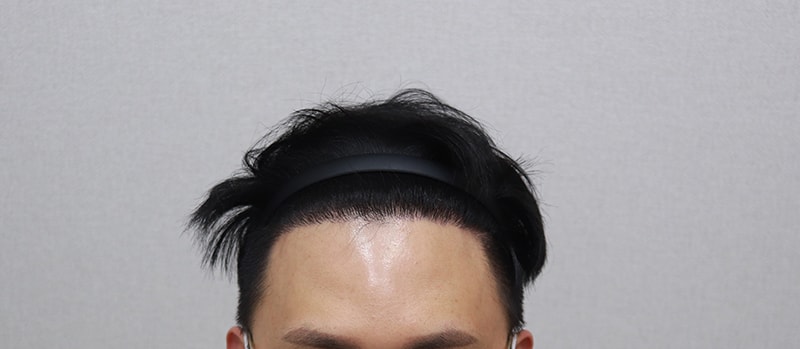 수술 6개월 경과 후기용1.JPG