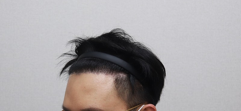 수술 6개월 경과 후기용3.JPG