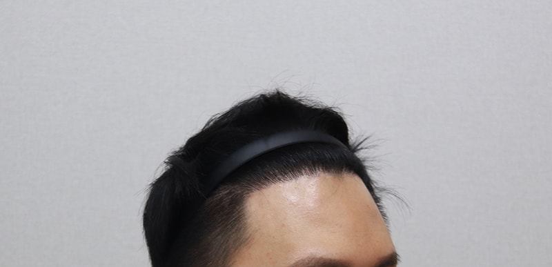 수술 6개월 경과 후기용2.JPG