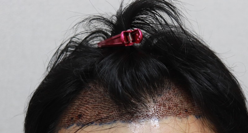 수술 다음날 후기1.jpg