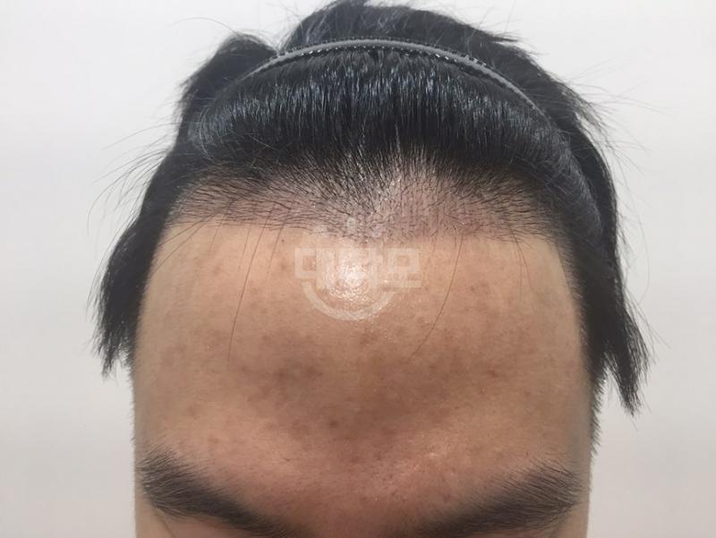 모바른 10개월 경과