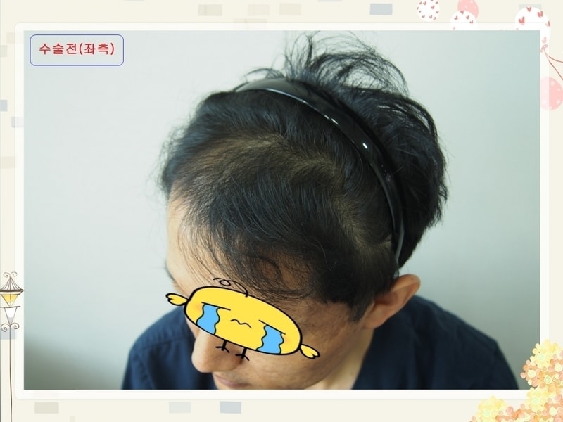 03.수술전(왼쪽).JPG