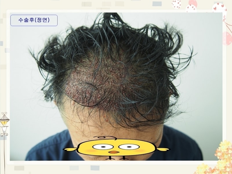 04.수술후(정면).JPG
