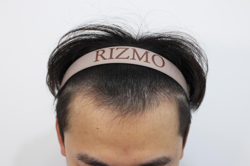 On the 14th day of the post-mortem hair transplantation of Rep. Lizmo in lower Busan