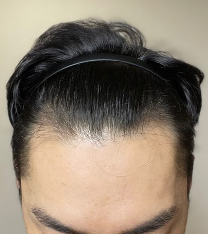 Let's share the process after 2500 hair transplants in DA plastic surgery.