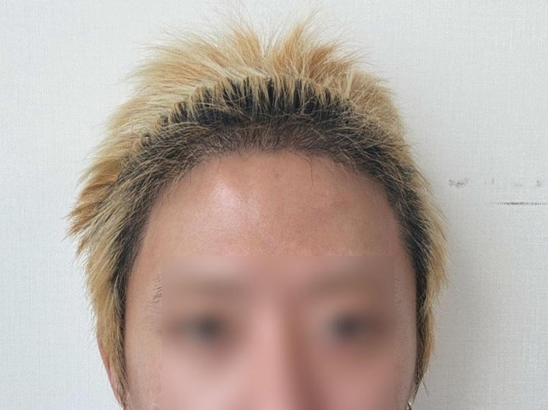 디에이 비절개 모발이식 투블럭컷 3000모 5개월차!!