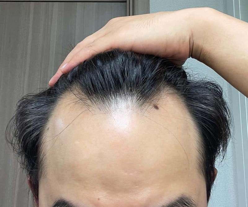イ·ドンウク院長の切開+非切開(ノーカット)4000毛混用2週間