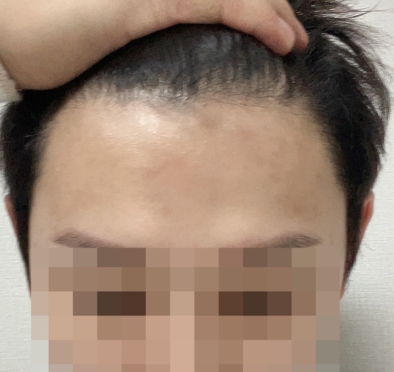 비절개 2000모 5개월 이제 잔머리 사라졌네요