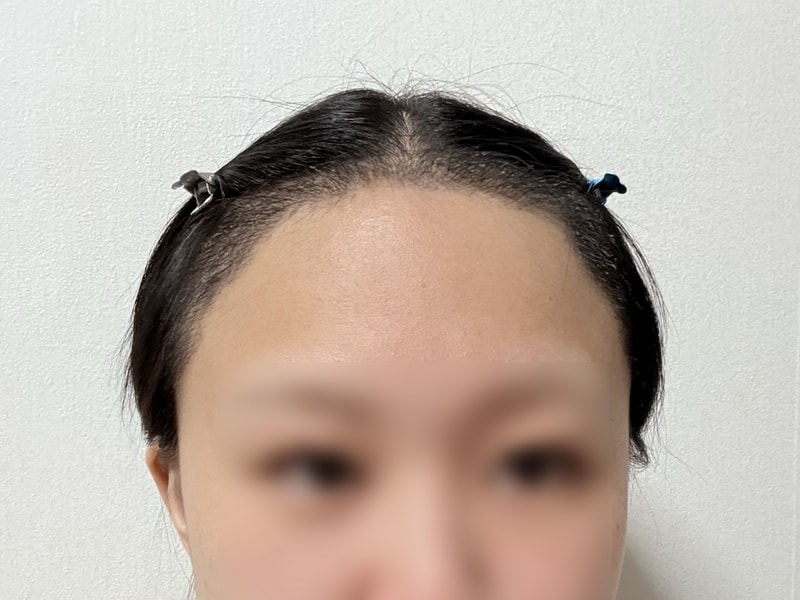 ♥DA 여자 M자 헤어라인 절개 모발이식 3200모 2주차 후기♥