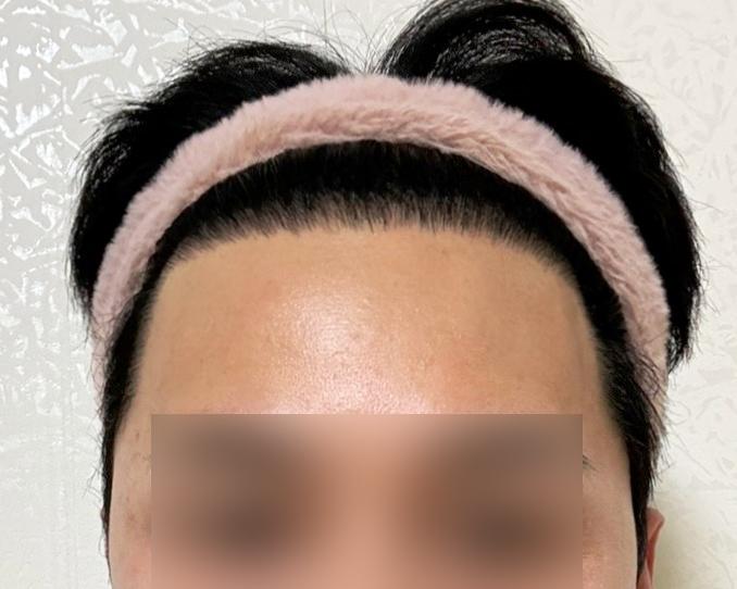 非切開ツーブロック 3000毛 10ヵ月目 レビュー