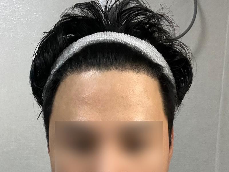 M字脱毛症 非切開 2800毛 レビュー 久しぶりに持ってきました
