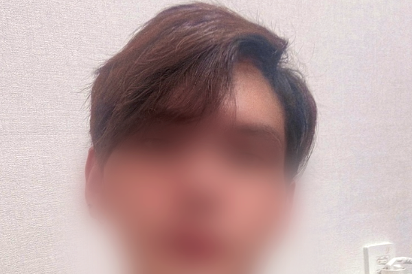 DA M-shaped non-cut hair transplant 2500 m. 7 months old