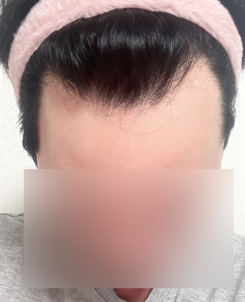 非切開ツーブロックカット3000本、 ぎっしりと上がってきましたね
