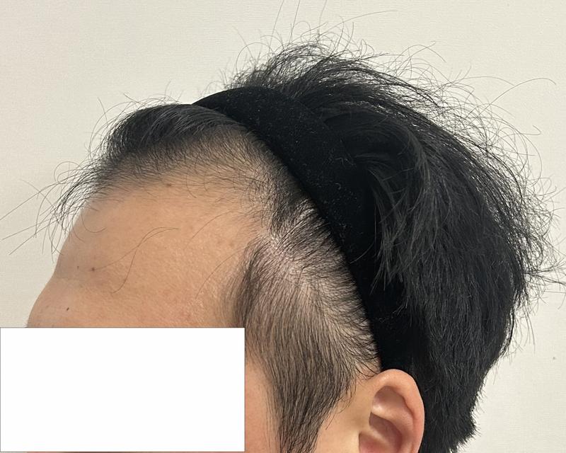 Director Lee Dong-wook of DA, M-ja + head hair loss mix 5,500 Mo 7 months review