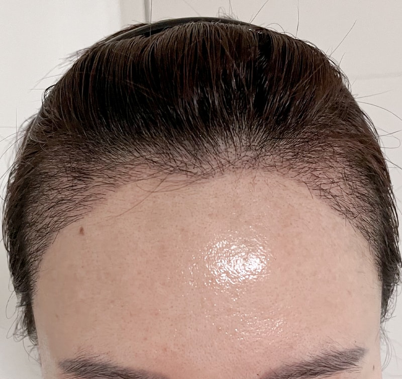沈M型发际线第3个月近况
