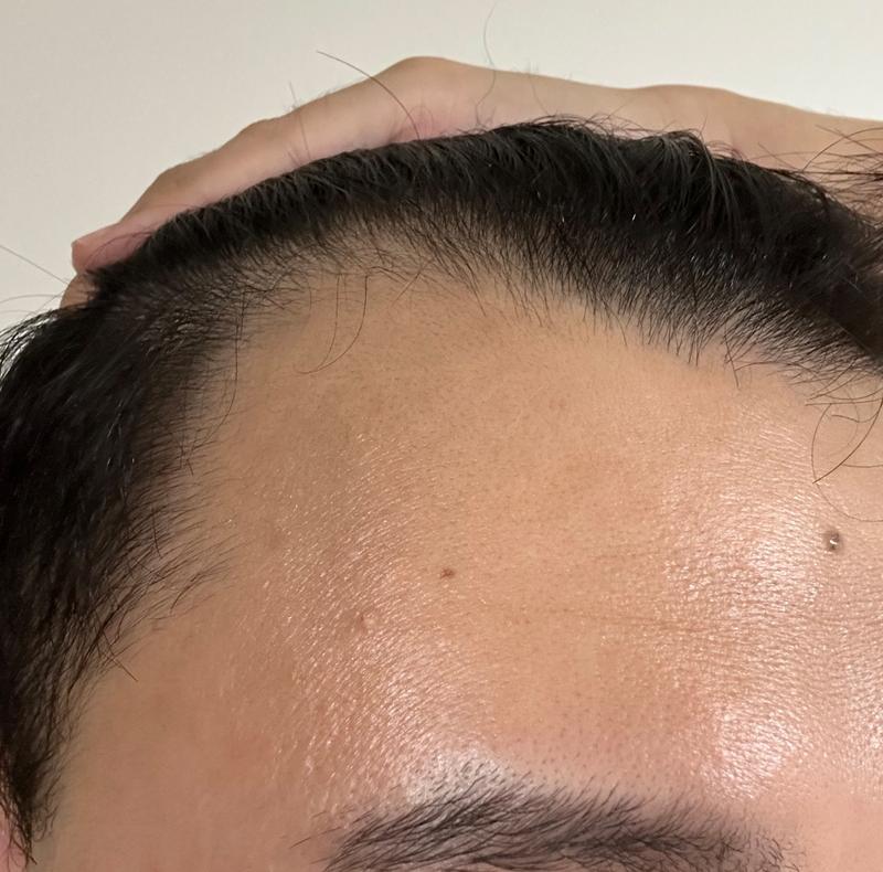 Non-cut 2200mo hair loss hair transplant in 5th month