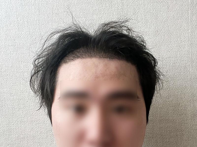 ディーエイ(DA) Mザイマ 非切開 毛髪移植 3700毛 2週目を感じた点