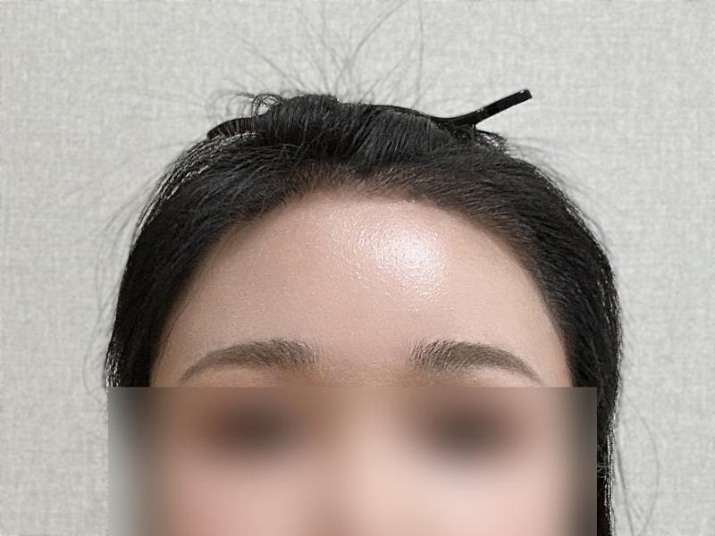 DA混用毛髪移植4000毛暗黒期なしで4ヶ月目になりました！！