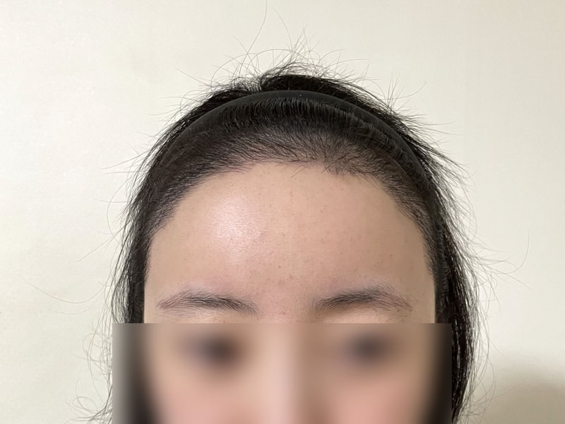 ディーエー女性毛髪移植混用4500本、一ヶ月目のレビューを持ってきました！
