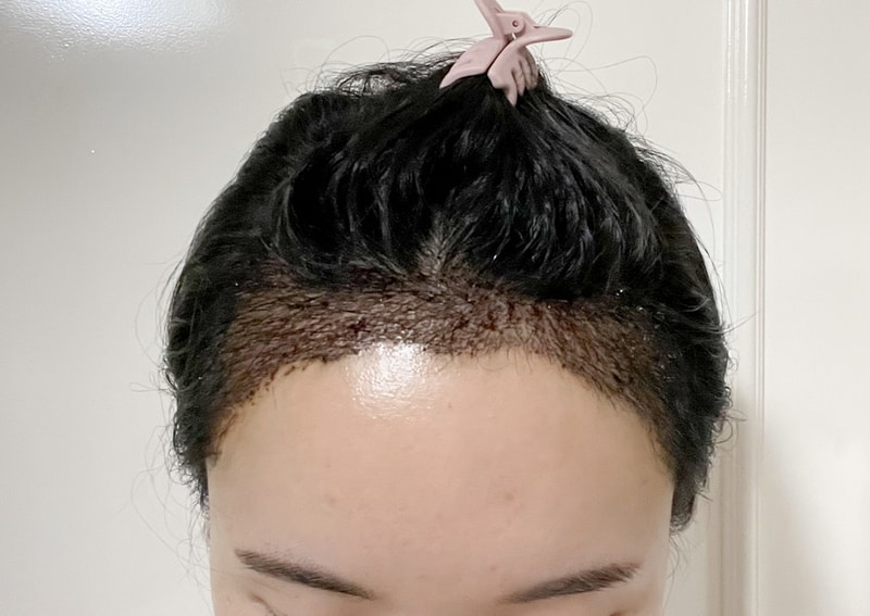 The A 发线矫正手术第5天！ 切开3500头！