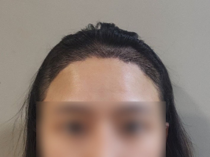 女性 広い額 M字 ヘアライン 切開 3700本 一週間目 レビュー！！