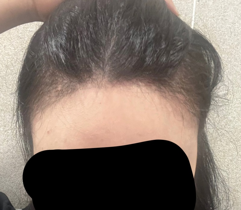 My hair is growing back after cutting 3000 hair dark days lol