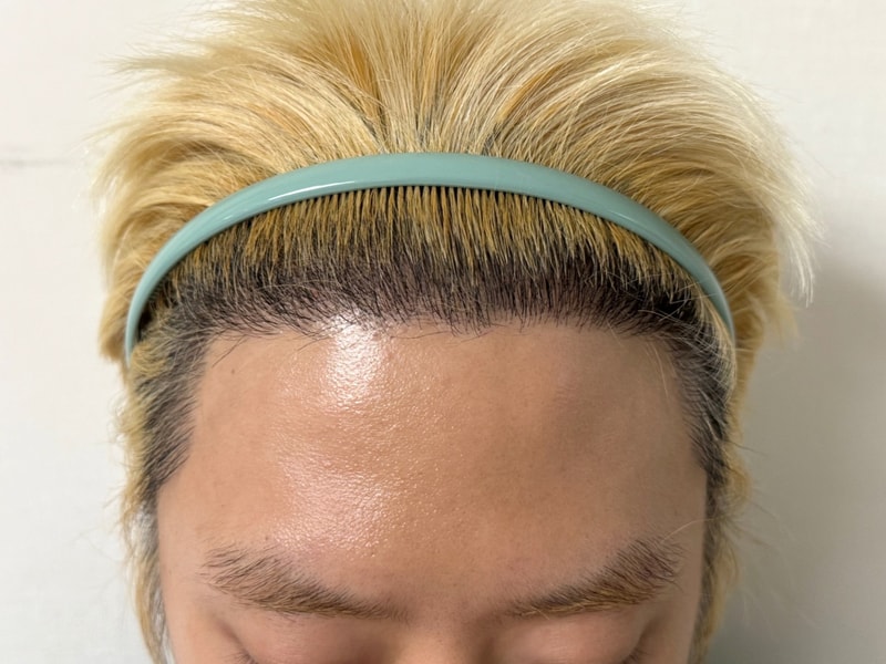디에이 비절개 모발이식 투블럭컷 3000모 7개월차 솔직후기bb