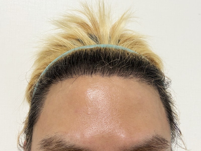 디에이 비절개 모발이식 투블럭컷 3000모 8개월 감격스러운 밀도!!