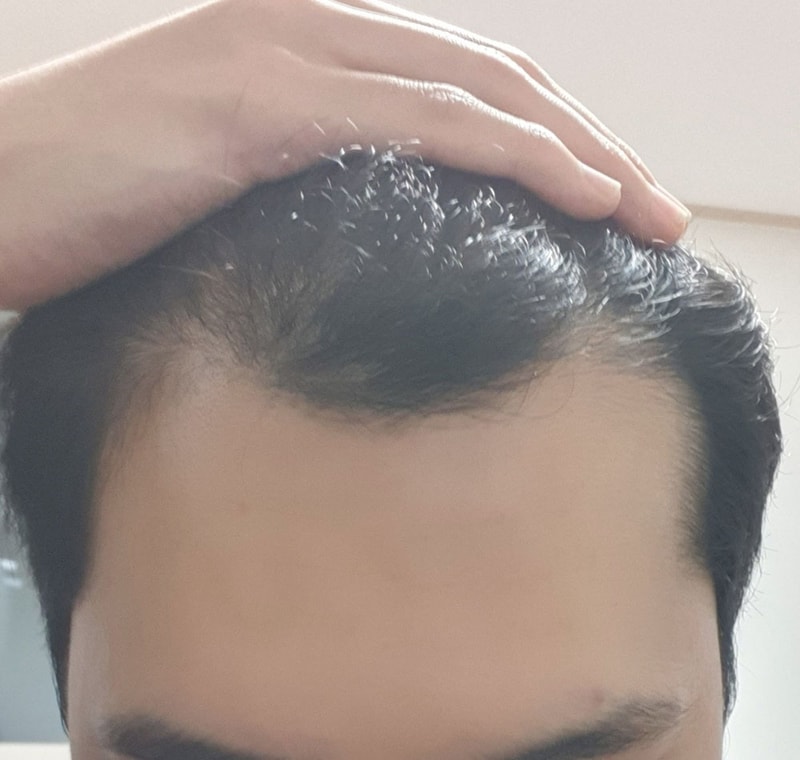 헤어라인 비절개 투블럭컷 모발이식 2일차