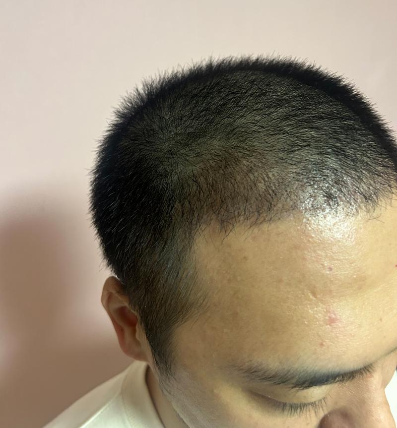 Modal transplantation 1 month later (for recording)