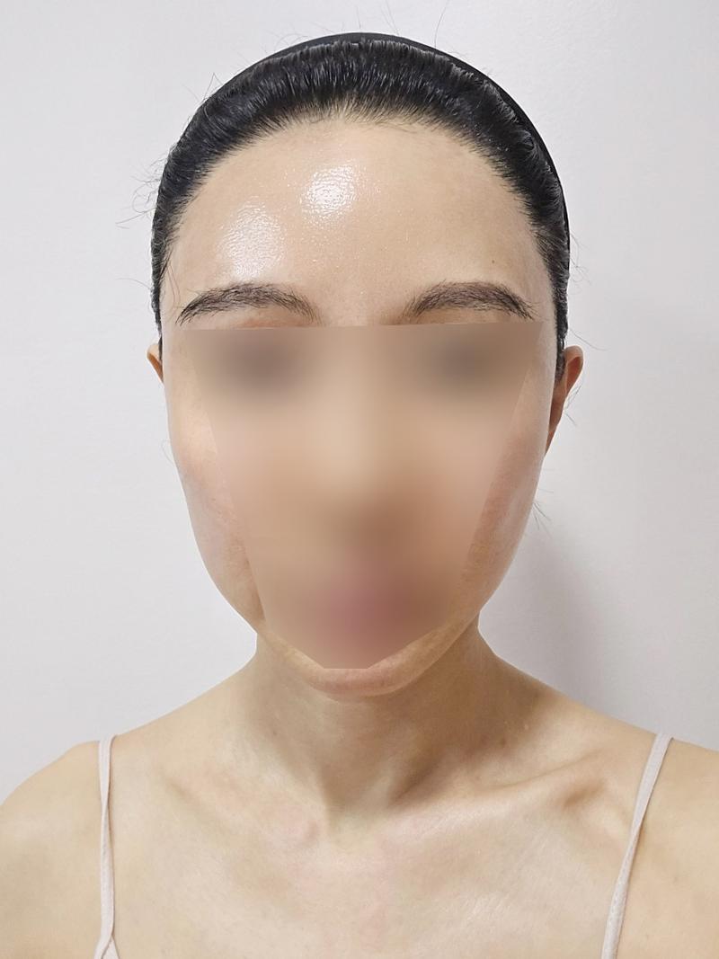 发际线，眉毛移植较晚的10个月后期(3200毛)