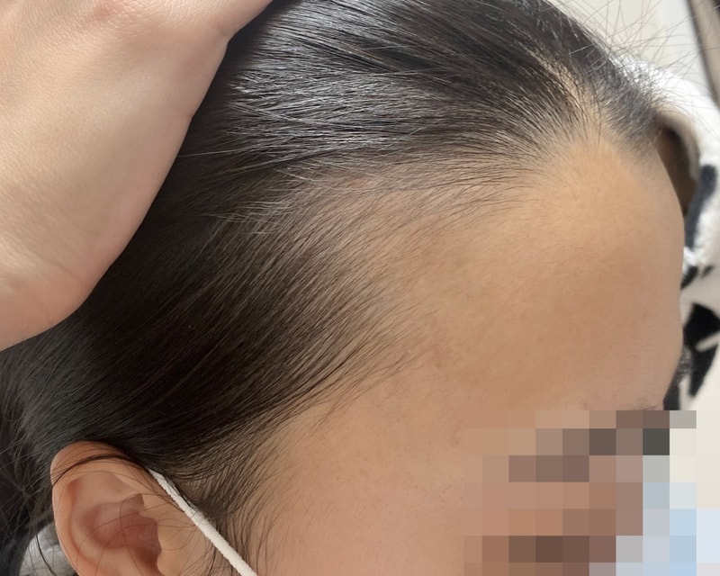 3者ヘアライン 3000毛 6ヶ月目