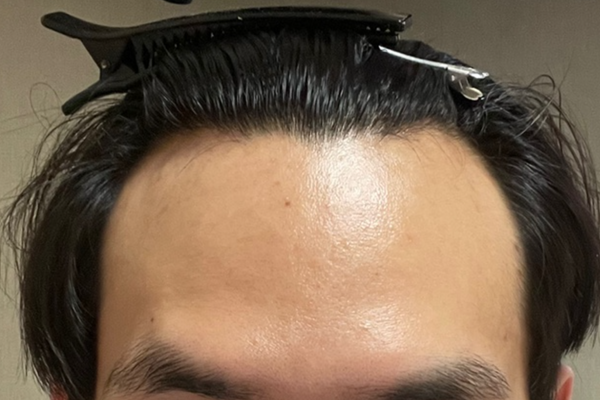 DA M-shaped men's hair transplant 2,500 mothers (4 months)