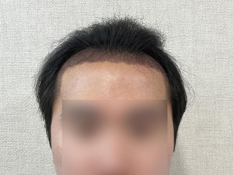 ディーエイ(DA) Mザイマ 非切開 毛髪移植 3700本 4日目 率直後記(多少の長文)