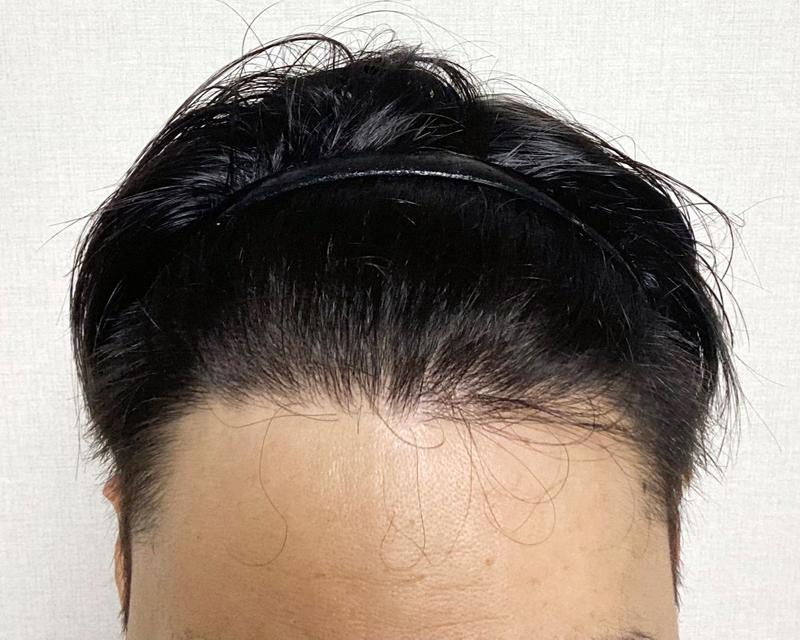 엠자탈모 비절개 투블럭컷 2873모 1년차 후기