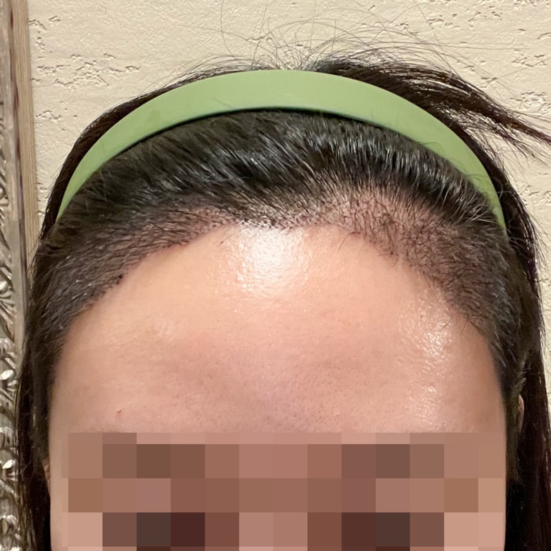 发际线3000毛后记！！！真的强力推荐！！