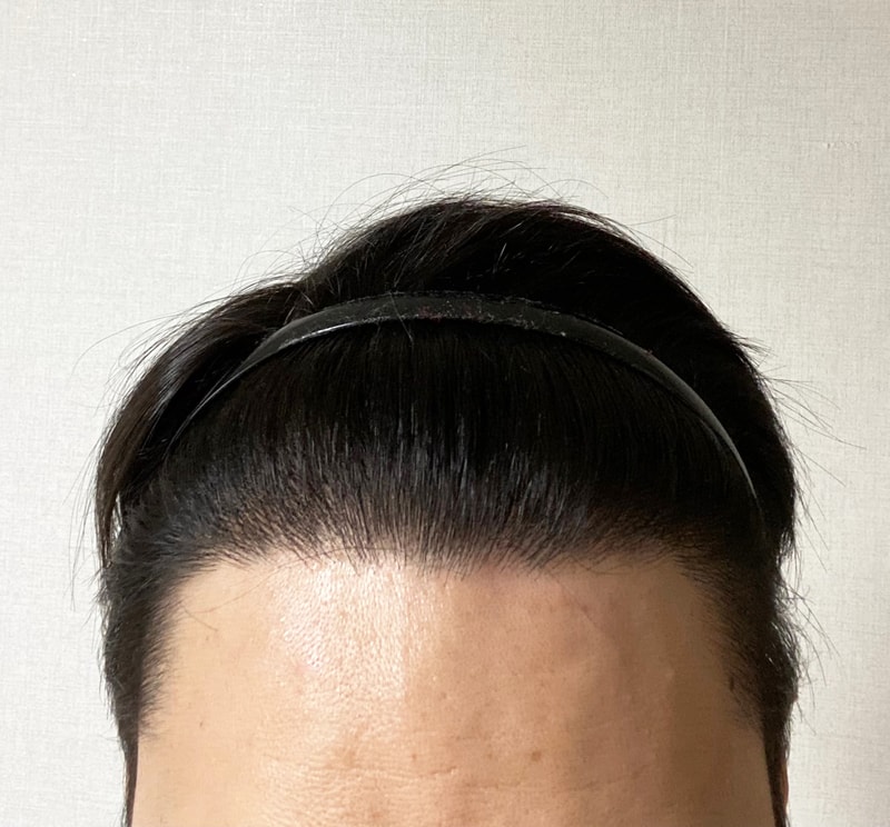 DA성형외과 엠자탈모 비절개 투블럭컷 2873모 1년 7개월bb굿