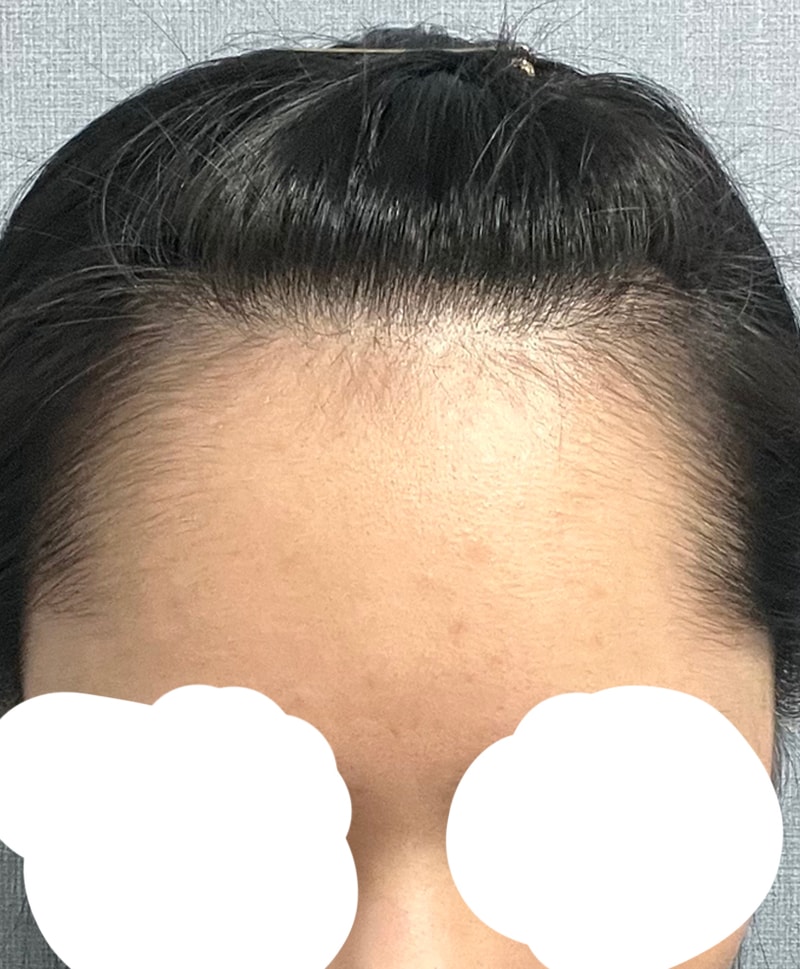 DA Plastic Surgery Hairline to share my 2nd week progress soon!!!